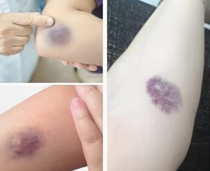 ΠΡΟΣOXH! Αν εμφανιστούν τέτοιες μελανιές στο σώμα σας, σημαίνει ότι έχετε κ…