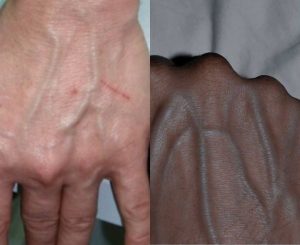 Αν οι φλέβες σας είναι ορατές στο χέρι σας, είναι σημάδι ότι έχετε κ..