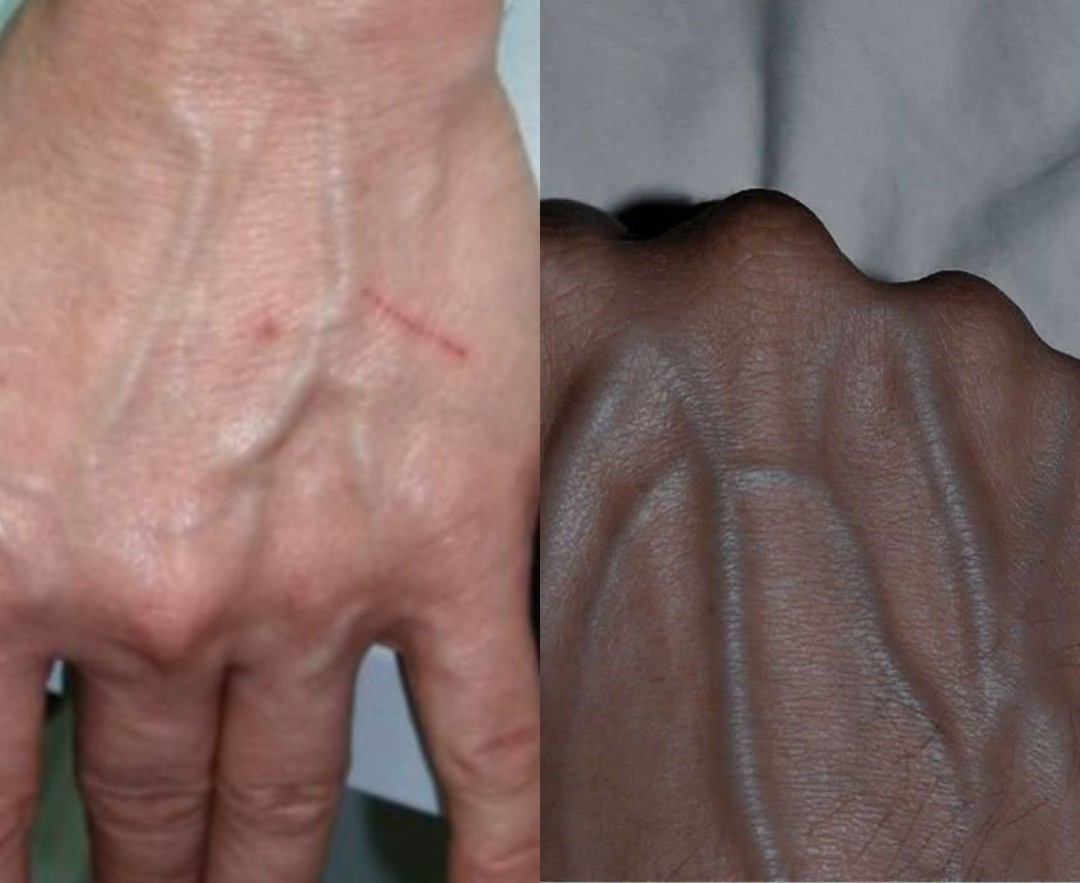 Αν οι φλέβες σας είναι ορατές στο χέρι σας, είναι σημάδι ότι έχετε κ..