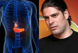 Με αφορμή τον θάνατο Λορέντζο Καριέρε: Οι 7 ενδείξεις καpκίνου στο πάγκρεας – Η ασθένεια που δεν δίνει σημάδια μέχρι να είναι αργά